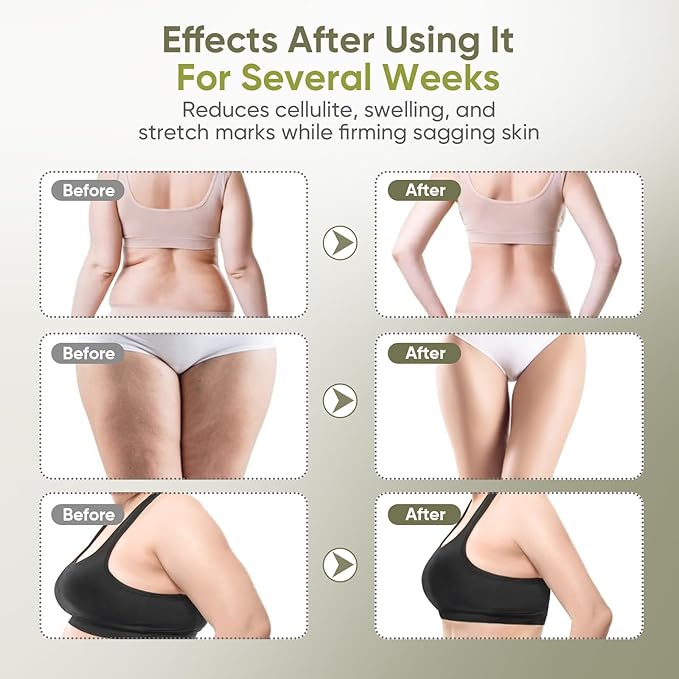 Lymphatic Drainage Massager &amp Anti-Cellulite Tool - Body Sculpting Machine with Microcurrent Light Heat &amp Vibration for Legs Arms Belly | Reduces Stretch Marks &amp Cellulite