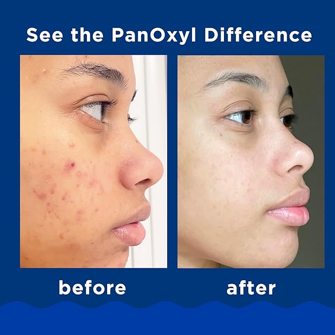 Vanicream Gentle Body Wash and PanOxyl 10% Benzoyl Peroxide Acne Foaming Face Wash Bundle