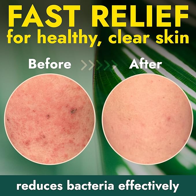 Antibacterial Body Wash with Tea Tree Oil | Antibacterial Soap for Men &amp Women | Kills 99.9% of Germs &amp Bacteria | Helps with Back Acne Body Odor &amp Skin Irritation | Daily Body Cleanser 1