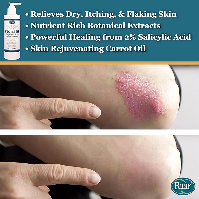 BAAR Psoriasis Therapeutic Scalp &amp Body Wash Soothing Healing Formula with 2% Salicylic Acid and Antioxidant-Packed Botanicals like Carrot and Lemon Oil to Relieve Itchy Dry Skin 8 fl oz